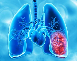 Lung Cancer: Early Signs, Symptoms & Prevention - Empowering Intimacy™